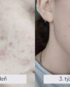 Recenzia dermálneho krému Dermal C. Urýchlil hojenie akné