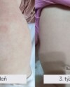 Recenzia dermálneho krému Dermal B. Rýchla pomoc pri atopickej dermatitíde
