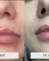 Recenzia dermálneho krému Dermal C. Krém je fantastický